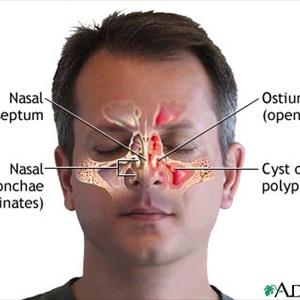 Dizziness And Sinus Problems - Balloon Sinuplasty Cures Blocked Noses Without Invasive Surgery