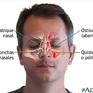 Sinitiis And Swollen Face Headache 