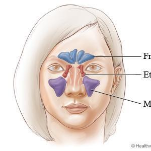 Natural Remedies For Sinus Problems - Xylitol Glossary Of Reduction As Well As Benefits