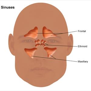 Sinus Polyps - Sinusitis Vaporizer Treatment