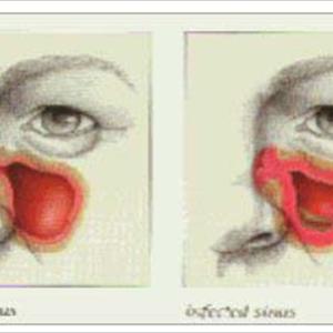 Can An Infection Increase The Blood Pressure - Treating Sinusitis Together With Nasal Nebulizer