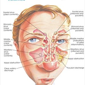 Swollen Sinus Glands In Nose - The General See And Medical Evidence Of Bronchiectasis