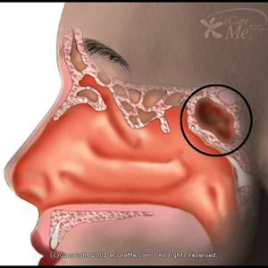 How To Know Bacterial Sinus - Eliminate Your Own Stutter Through Ari Kreitberg Review.