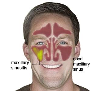 Serious Sinus Trouble - Things To Know About Sinusitis: Definition, Symptoms, Causes, And Treatment