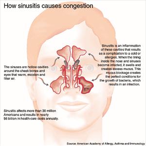 Smelling Burning In The Nose - Basic Information On Sinusitis Treatments