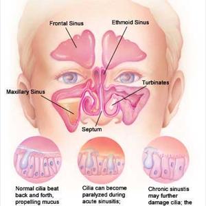 Sinus And Dizziness - What Tend To Be Sinus Infections