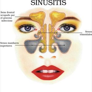 Getting Sinuses To Drain - Sinus Headache Symptoms And The Way To Alleviate Them