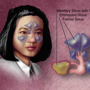 Pain Sphenoid Sinus - Natural Sinusitis Remedies: Simple Applications