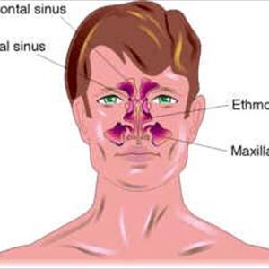 Sinus Infection Above The Eye - Understanding Sinusitis Symptoms And Its Treatments