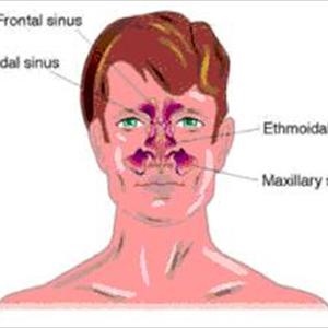 How To Treat Sinus Infections Naturally - Impacted Sinusitis Symptoms