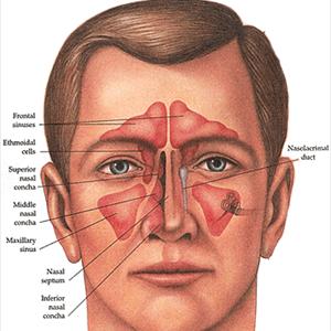 How To Deal With Upper Sinus Pain - Sinusitis Cure Programs